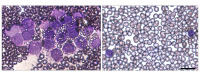 Cancer cells in untreated leukemia (left) are significantly reduced after ATRA treatment (right), which blocks a faulty β-catenin signal in the bone marrow that helps leukemia grow.
